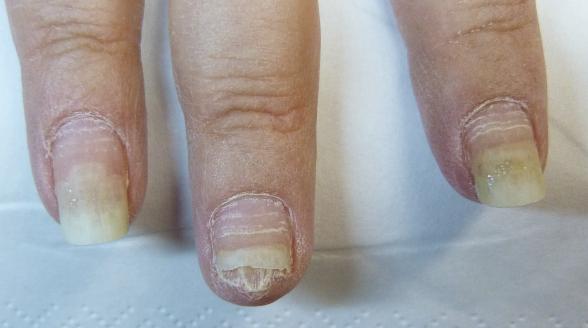 Brüchige Nägel nach der Chemotherapie